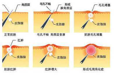 长痘痘8年了怎么办啊