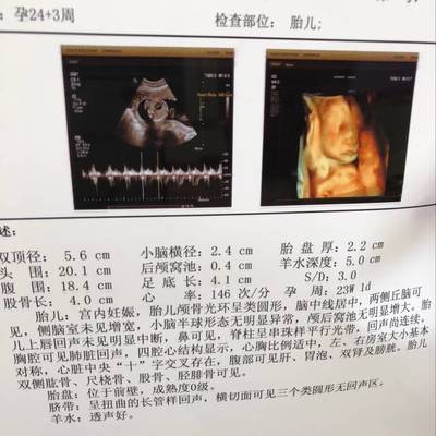胎儿的照片