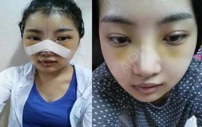 全切双眼皮拆线后