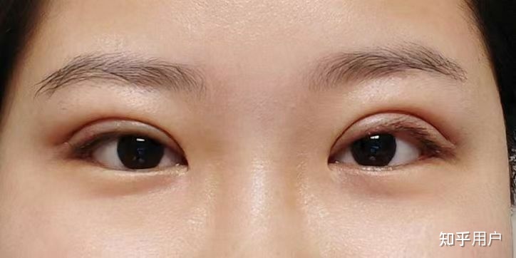 纳米双眼皮几天消肿