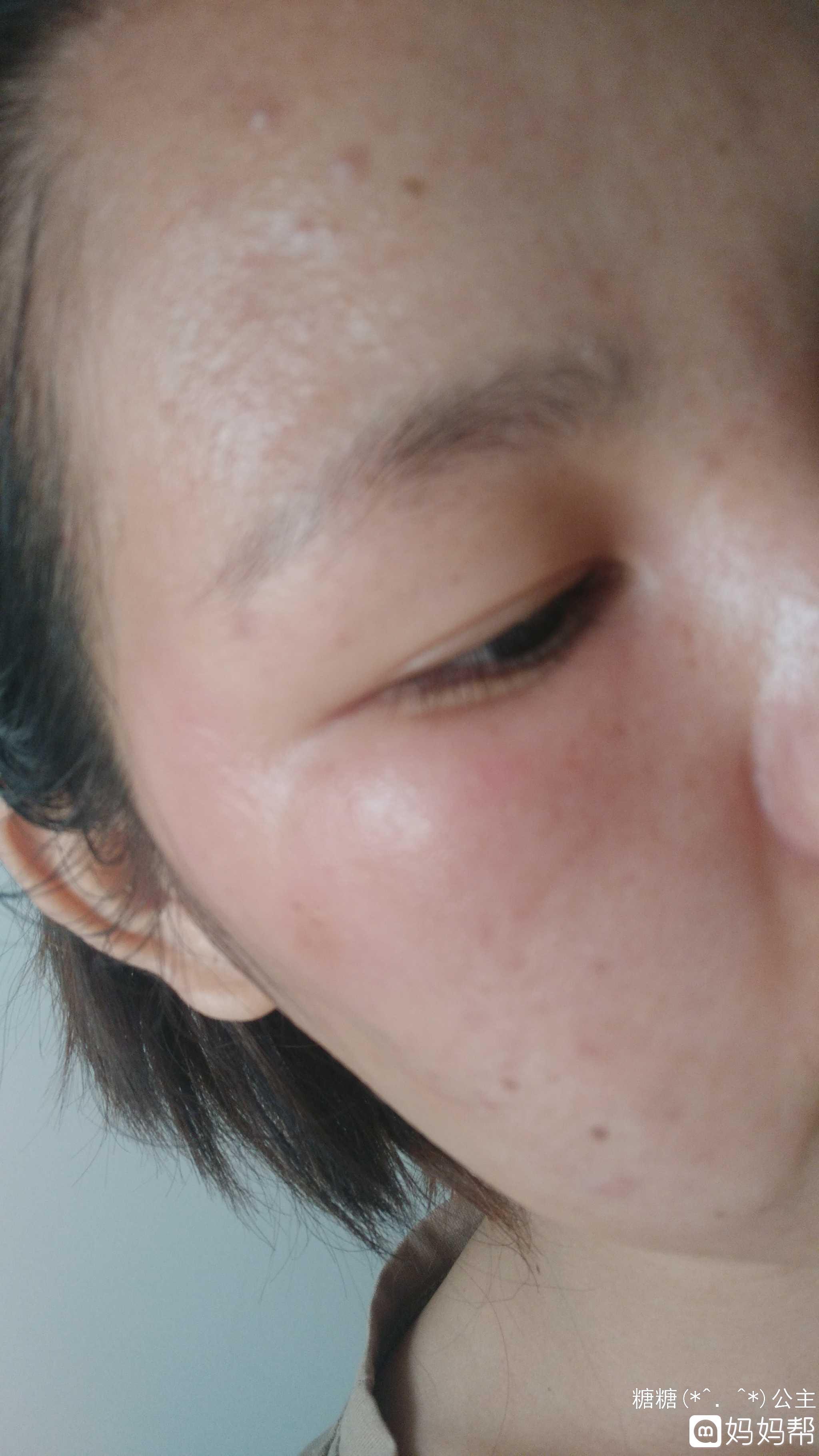 护肤品用了几天才过敏