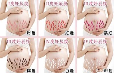 孕妇长妊娠纹的原因
