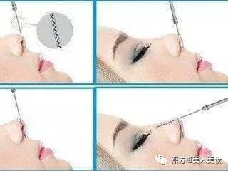线雕隆鼻一包多少根线
