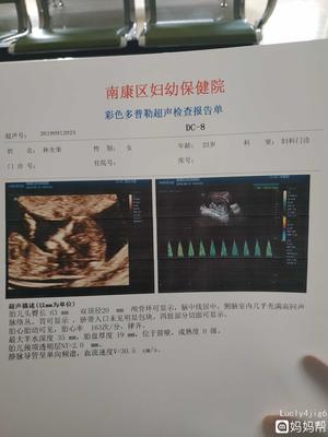 12周胎儿nt值正常范围