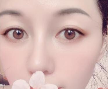 做了双眼皮多久能化妆
