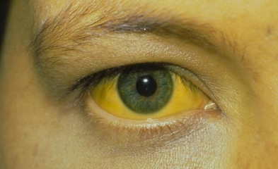正常眼睛怎么发黄
