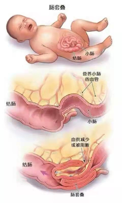 新生儿小肠坏死存活率