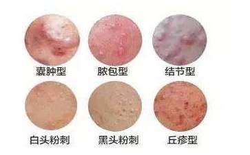 囊肿痤疮怎么治疗