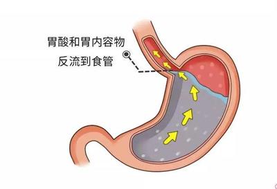 胃酸是怎么回事儿