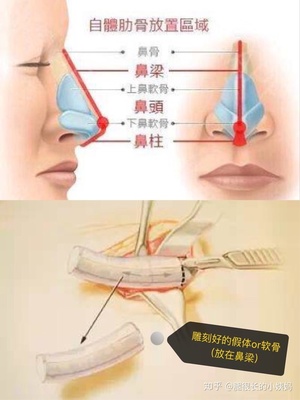 耳软骨隆鼻是永久的吗