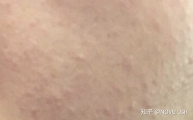 痘痘好了后留下脂肪粒