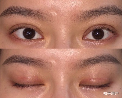 双眼皮刀疤多久能恢复
