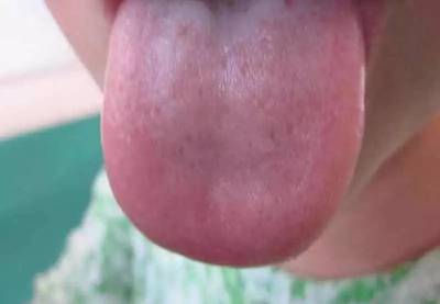 舌苔白又厚是怎么回事
