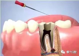 牙周炎可以矫正牙齿吗
