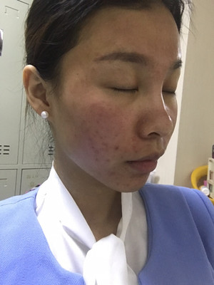 什么是微针祛痘