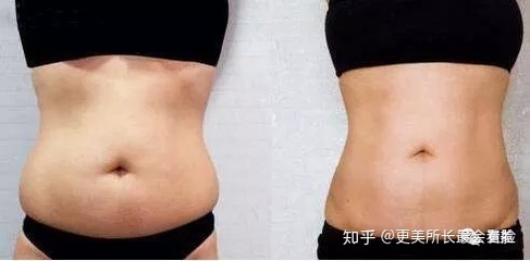 大腿抽脂减肥的费用