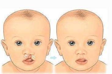唇裂一般遗传多少代人