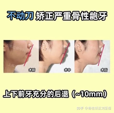 深覆合会怎样影响脸型