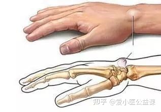 腱鞘囊肿是怎么引起的怎么治疗