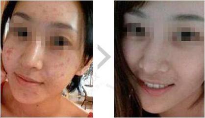 长痘痘痛苦