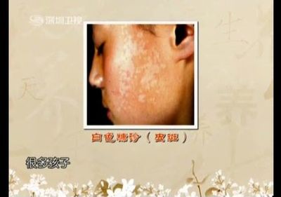 宝宝脸上有虫斑怎么办