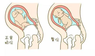 胎儿臀位