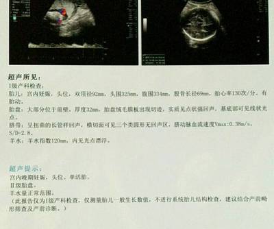如何检查胎儿是否入盆