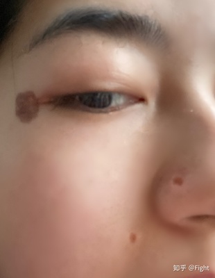 激光点痣会留疤