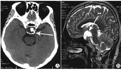 鞍内占位性病变是怎么照成的