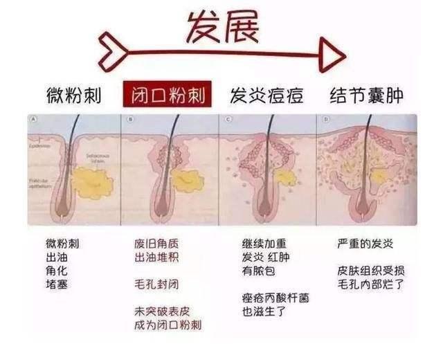 痘痘和粉刺怎么区分