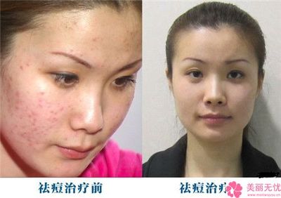 皮肤专家消除痘痘