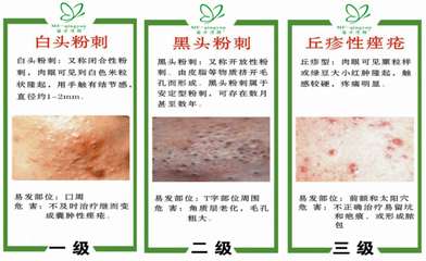 囊肿痤疮怎么治疗