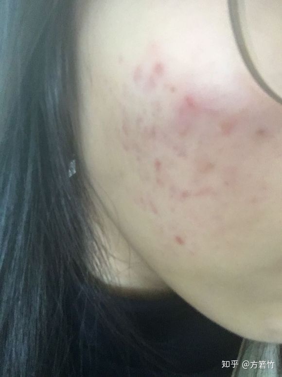 心口上长痘痘是怎么回事啊