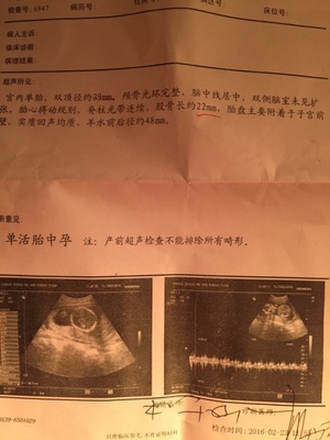 怀孕四个月怎么看男女