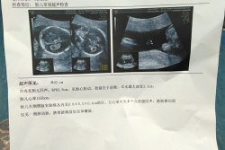 金华人民医院种试管婴儿多少钱