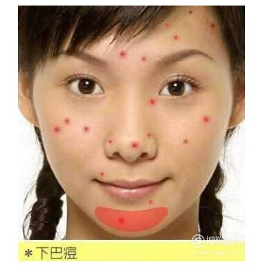 下巴长痘痘什么原因女