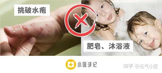 宝宝手足口病能洗澡吗