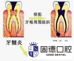 牙神经外露怎么治疗