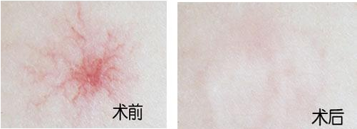 蜘蛛痣怎么治疗
