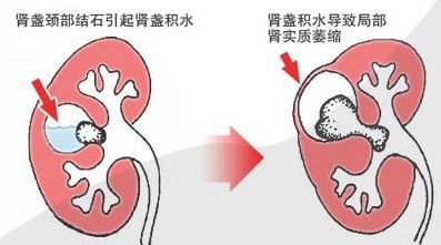 宝宝肾结石有什么症状