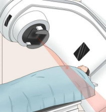 疤痕放疗