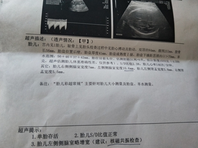 胎儿在左边
