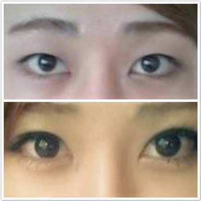 双眼皮眼睛小怎么变大