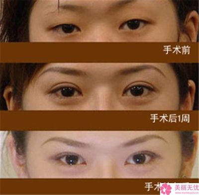 割了双眼皮需要注意事项