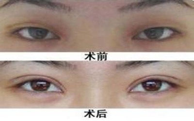 双眼皮埋线有风险吗