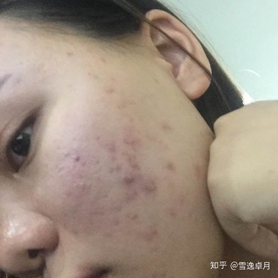 去美容院针清痘痘好吗
