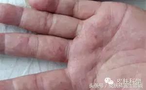 汗疱疹怎么治疗