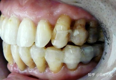 牙齿发炎怎么治疗