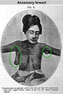 怀孕长副乳怎么办