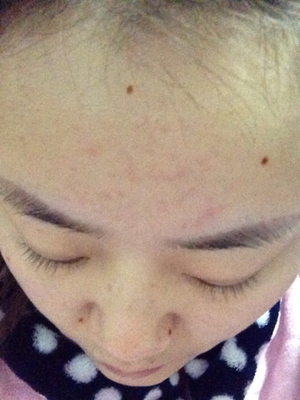 点痣多少钱一颗